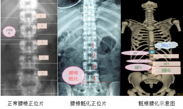 健康大讲堂骨科专题五腰椎骶化与骶椎腰化