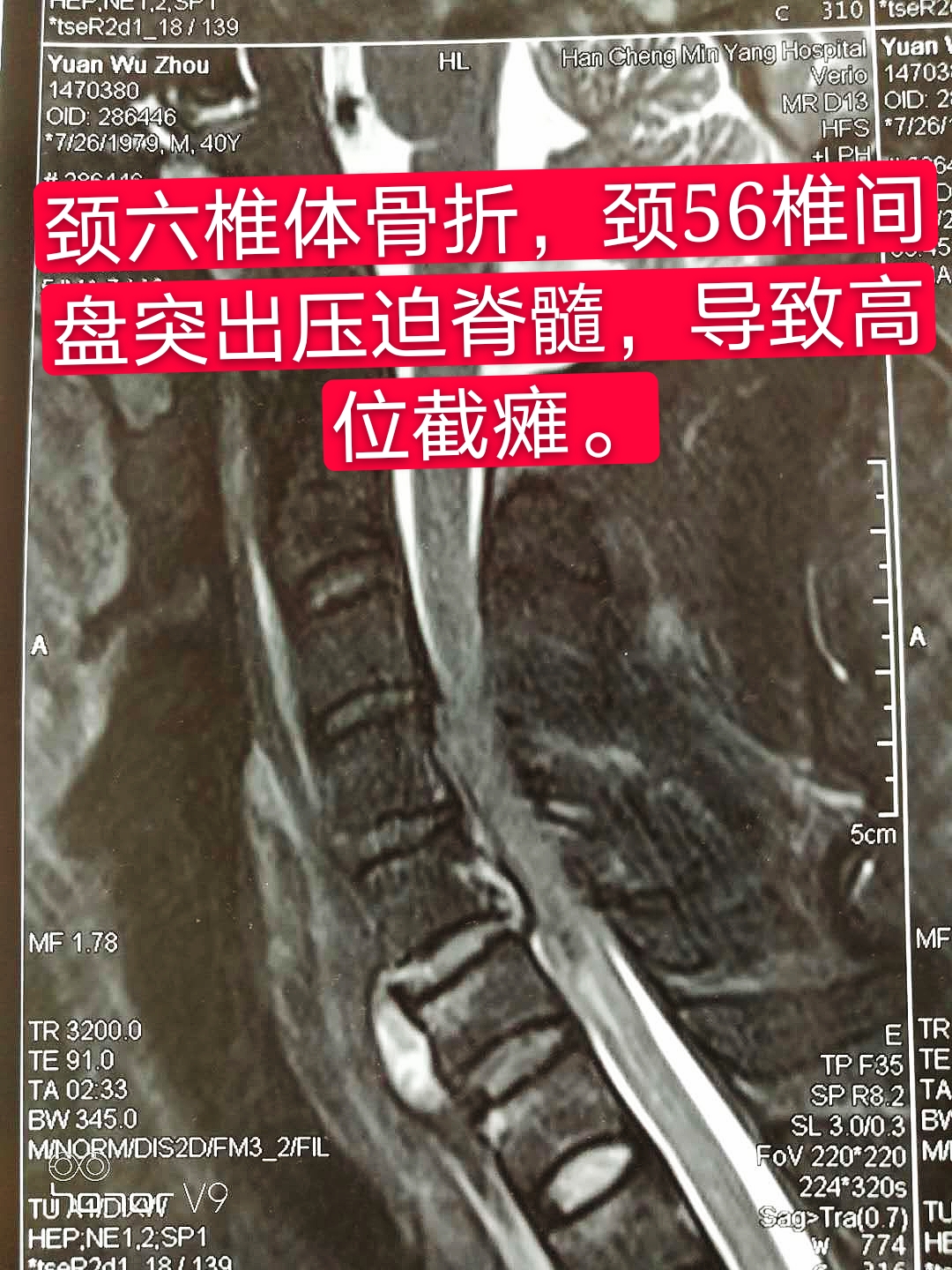 患者带来的当地医院的颈椎磁共振提示:颈6椎体骨折伴脊髓水肿,颈椎