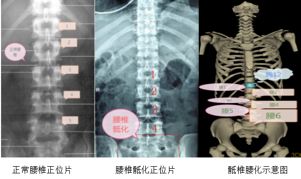 【健康大讲堂】骨科专题(五)腰椎骶化与骶椎腰化