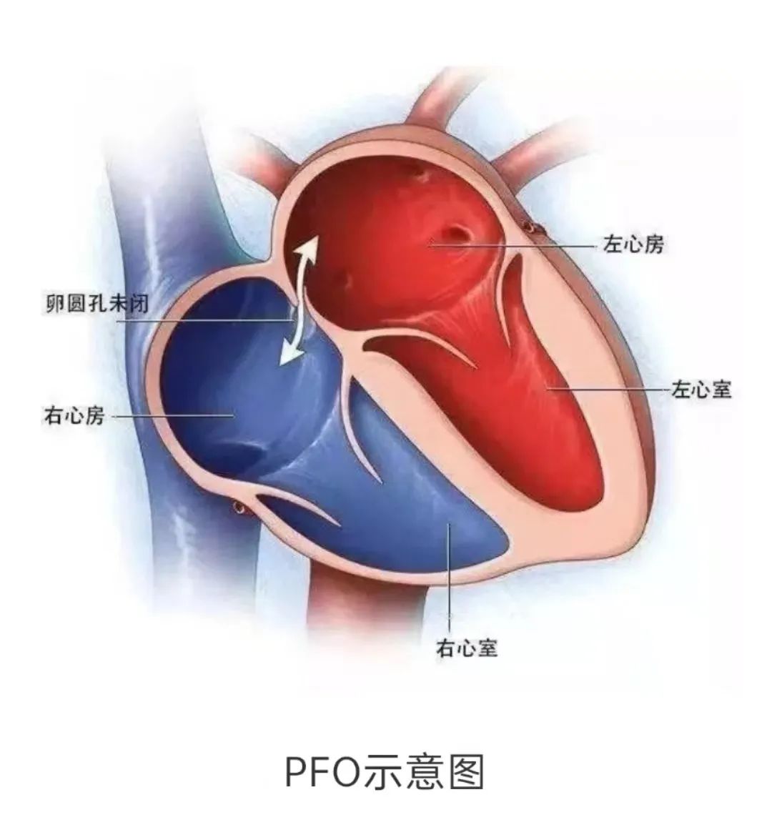 卵圆孔未闭解剖图图片