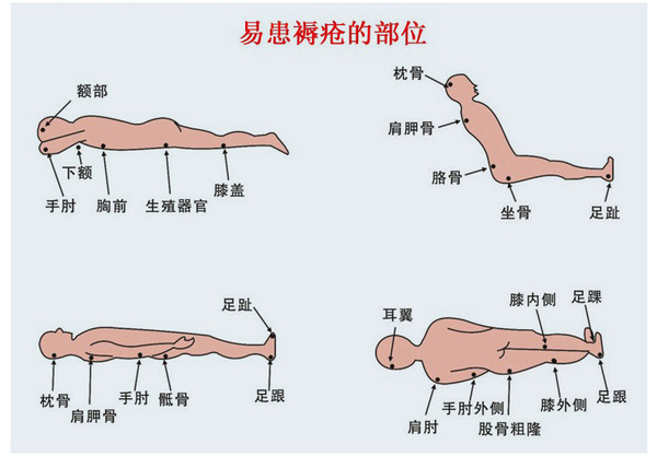 压疮卡通图图片