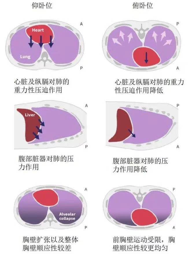 俯卧位通气流程图图片